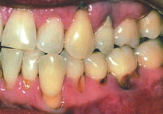 Tooth Decay - Generations Magazine - October-November 2012