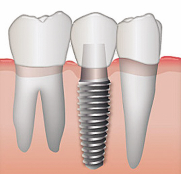 Dental Implants - Generations Magazine - February-March 2013