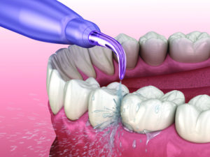 Irrigator, Water teeth cleaning. Medically accurate 3D illustration of oral hygiene.